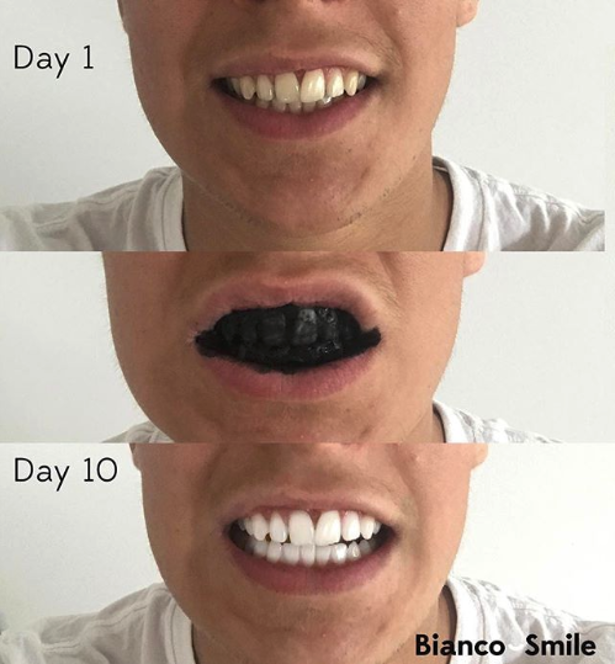 COMPETITION! Bianco Natural Teeth Whitening Kits & Win >> Activated Charcoal Whitening Powder! www.biancosmile.com Enter Here! | Rugby (AXIOS)